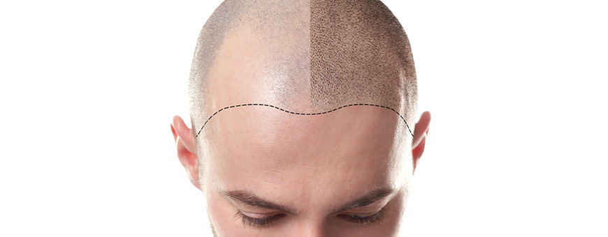 mesotherapy-hair-loss-responsive.jpg